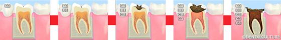 むし歯の発生要因と進行度